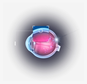 Eye - Suprachoroidal Cls Ta #579443