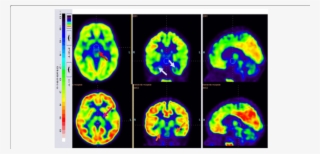 18 F-fdg Image Before Cellular Therapy Showing Reduced - Common Fig #5731258