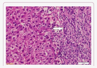 High Power View Of The Previous Slide Showed Numerous - Fibrosis #5731602