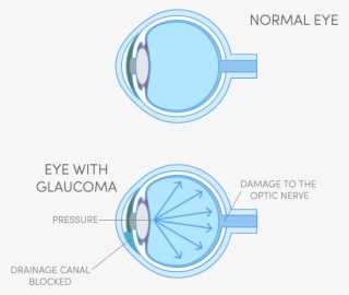 What Is Glaucoma - Circle #5867737