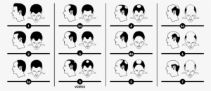 Norwood Scale For Male Hair Loss #593226