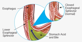 Gerd Lower Esophageal Sphincter - Stomach #5998673 Gerd Lower Esophageal Sphincter - Stomach #5998673