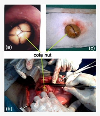 Endoscopic View Of The Cola Nut Blocked In The Esophagus - Esophagus #5998933