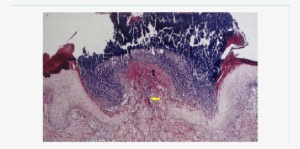 Histopathology Showing Prominent Epidermal Hyperplasia - Epidermis #61338