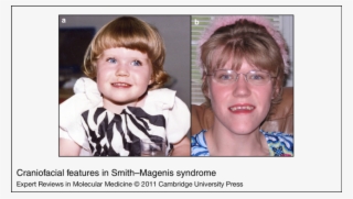 Download - Smith Magenis #6006004