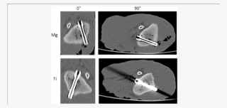 Mg Screw And Ti Screw (bottom) In Mdct In - Common Fig #6037923