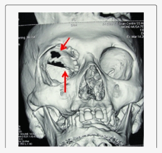 3 'd' Ct Image Showing Destruction Of Right - Sphenoid Bone #6168317