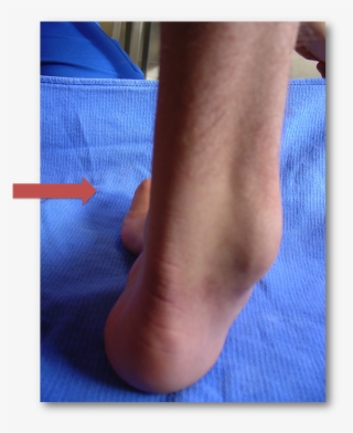 Charcot Marie Tooth Heel Varus - Thickened Nerves Charcot Marie Tooth #6272678