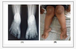 A] Knock Knee/genu Valgum B] X Ray Foot Showing Short #6326671