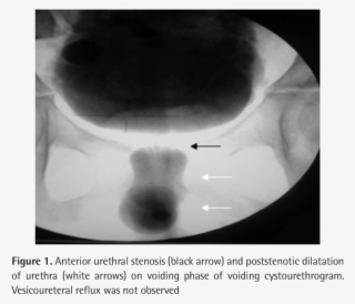 Cystourethroscopy Confirmed The Presence Of The Auv #6356593
