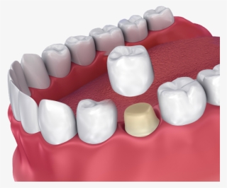 Dental Crown #6377104