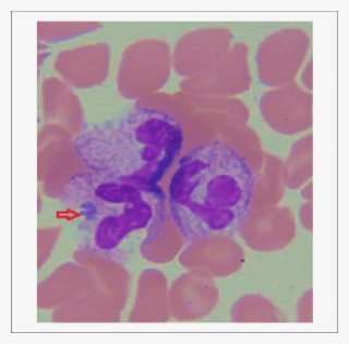 Peripheral Smear From Hospital Day Showing Rare Morula - Morula Inclusions #6457017