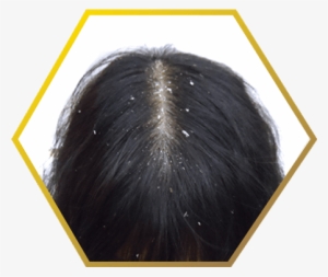 Dandruff Related Hair Loss- Jonsson Protein Singapore - Stop Sign Graffiti #650117