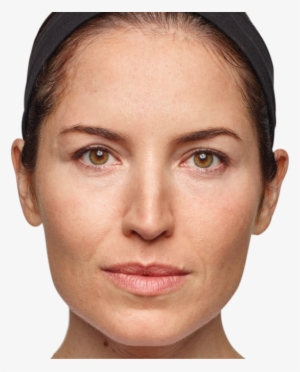 Woman Before And After Dysport Treatment - Dysport Injections #651183