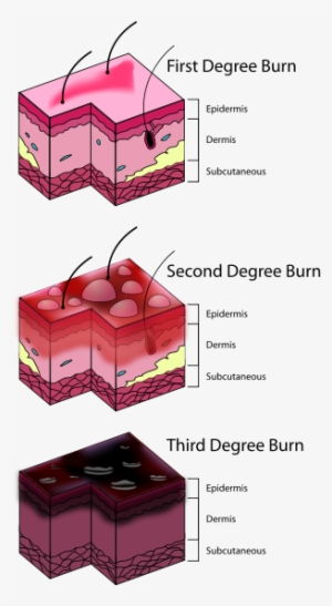 Degrees Of Burn #652434