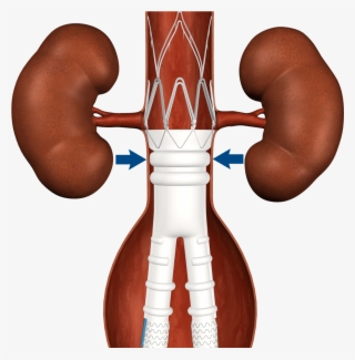Stent Graft Comparison #6663294