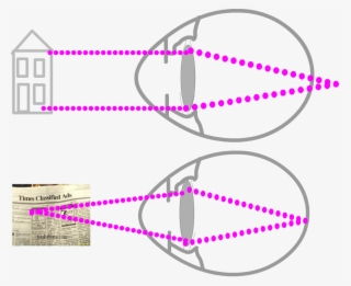 Opposite Of Myopia Medical Information And Advice #6687940