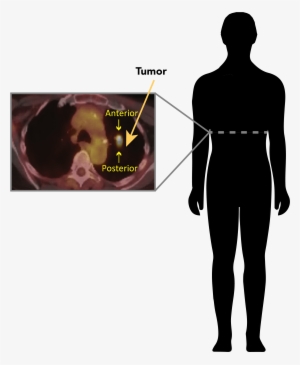 Positron Emission Tomography Can Be Used To Detect - Standing #678143