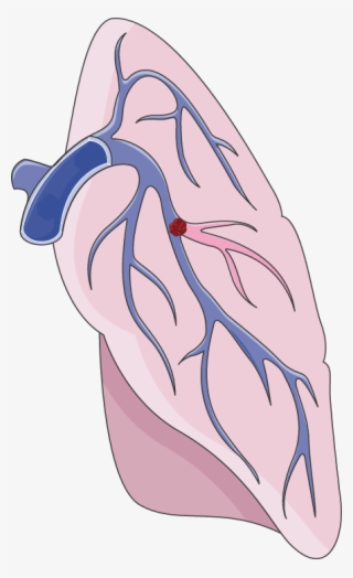 Pulmonary Embolism #6733861 Pulmonary Embolism #6733861