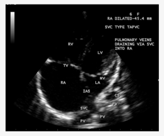 Svc Type Total Anamolous Pulmonary Venous Connection #6844588