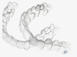 Braces With Barely A Trace #6882095
