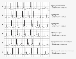 Electrocardiogram Waveforms And Vital Signs Were Retrieved #6894861 Electrocardiogram Waveforms And Vital Signs Were Retrieved #6894861