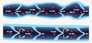 Varicose Veins By A Different Name - Vein #696191