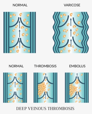 Varicose Veins - Graphic Design #696843