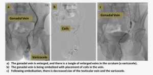 Varicocele Embolization Original - Varicocele Embolization #696889