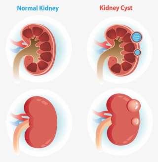 Are Kidney Cysts Rare #6969298