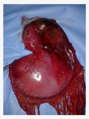 Specimen Of The Resected Stomach - Duck Meat #709991 Specimen Of The Resected Stomach - Duck Meat #709991