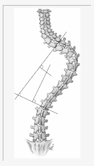 Measurement Of The Cobb Angle #7008614