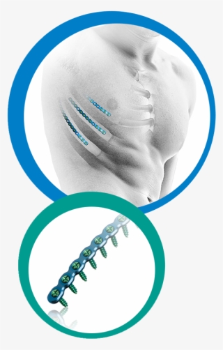 Rib Fixation #7077408