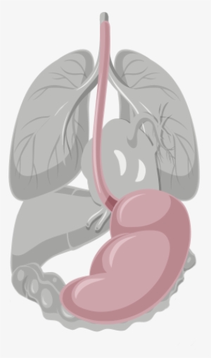 Stomach Cancer, Or Gastric Cancer, Is Due To An Abnormal - Illustration #710447 Stomach Cancer, Or Gastric Cancer, Is Due To An Abnormal - Illustration #710447