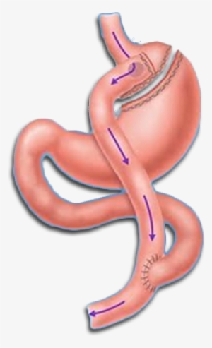 Bmi Calculator - Weight Loss Bypass Surgery #710948
