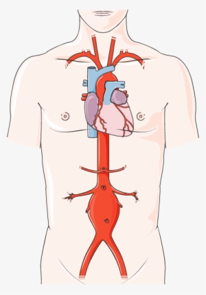 Abdominal Aortic Aneurysm - Cardiac Catheter Procedure #716536