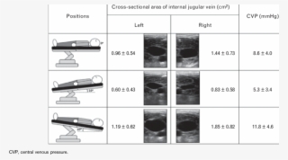 Cross-sectional Area Of Left And Right Internal Jugular #7114813