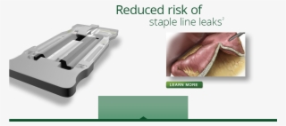 Staple Line Bleeding1* #7216934