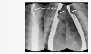 Upper Gastrointestinal Series Showed The Bayonet Sign, #7414264