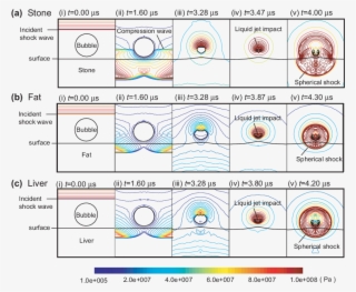 Bubble Collapse Near Stone, Fat, And Liver Boundaries #7444775 Bubble Collapse Near Stone, Fat, And Liver Boundaries #7444775