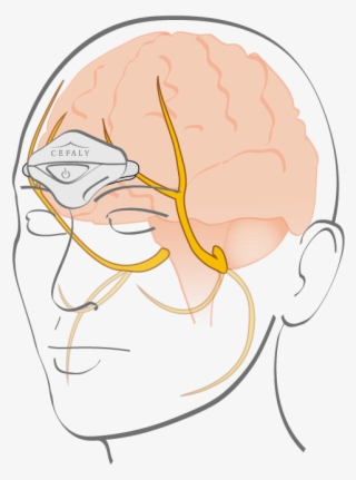 Treatment And Prevention Of Miraine #7467736