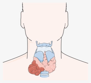 Cancer De La Thyroïde #7476415
