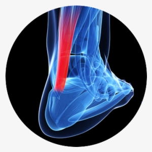 Elute® Fiber Is Driving A Paradigm Shift In Tissue - Entesopatia Do Tendao Calcaneo #754291