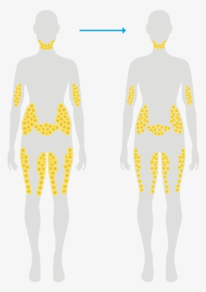 Fat Cells After Typical Weight Loss - Man #769249