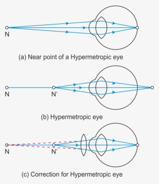 Presbyopia - Diagram - Free Transparent PNG Download - PNGkey