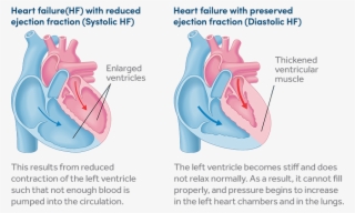 Two Types Of Heart Failure - Diagram #7622870