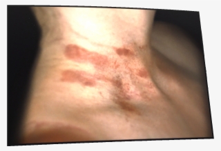 Bruises Png #7624487