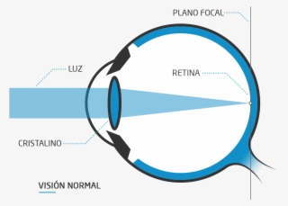 Como Consecuencia, Los Rayos De Luz No Llegan Correctamente - Ojo Con Miopia Png #7635212