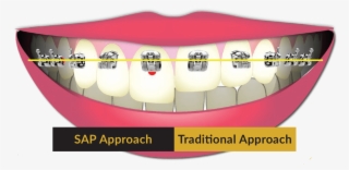 Saoly Benson Utilizes Smile Arc Protection When Treatment - Tongue #7774831