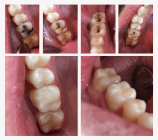 Utica Dental Fixing Old Mercury Fillings - Macro Photography #7774874